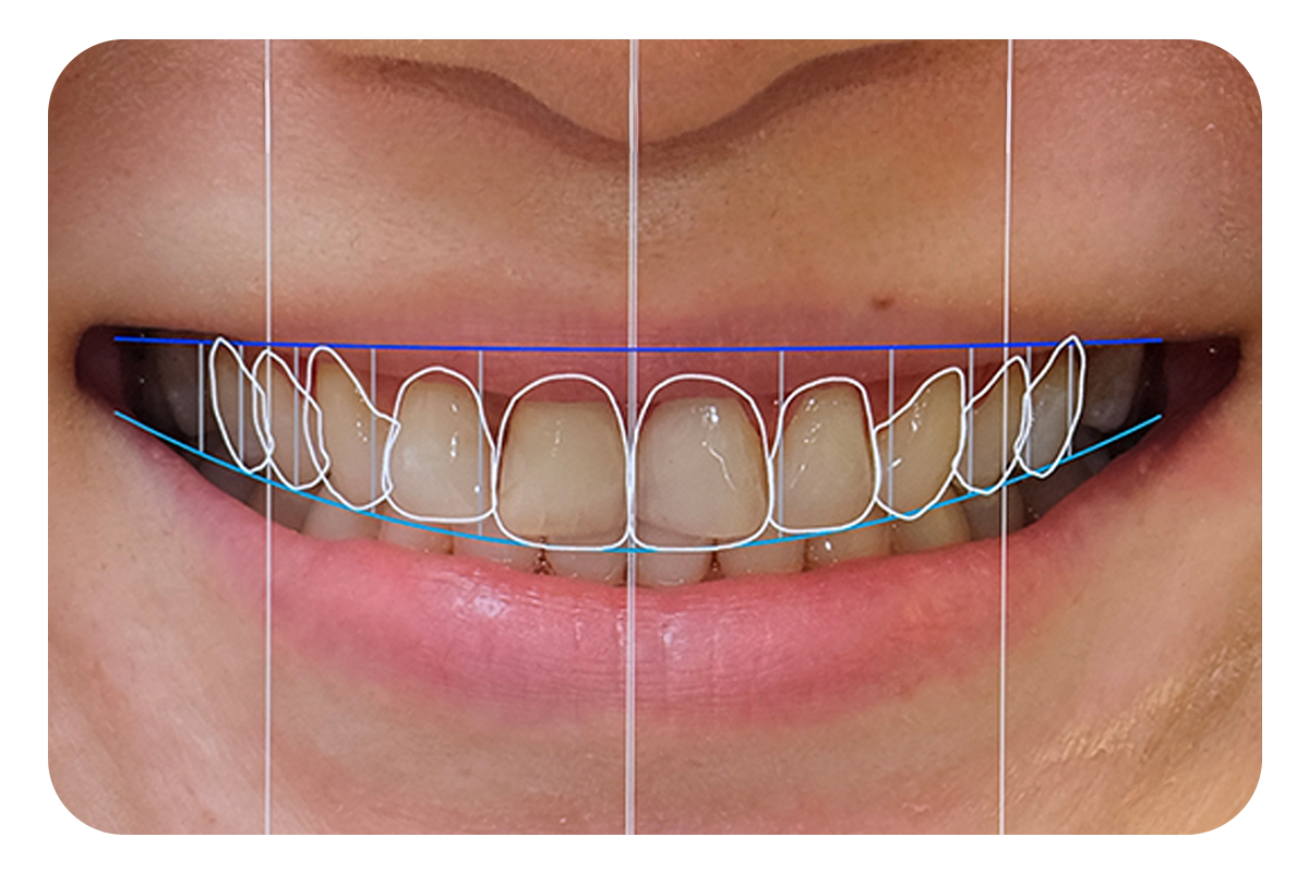 Veneers 4-Stage Plan